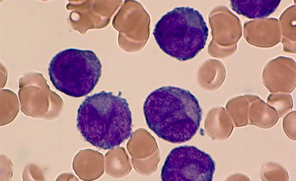 家庭裝修是導致白血病的***因素！家里甲醛超標怎么辦